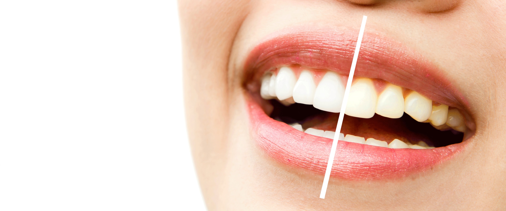Smile Brighter with the Best Cosmetic Dentist in San Diego: Your Guide to Perfect Teeth