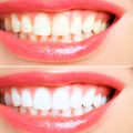 Discover the Teeth Whitening Best Method: Achieve a Gleaming Grin in No Time!