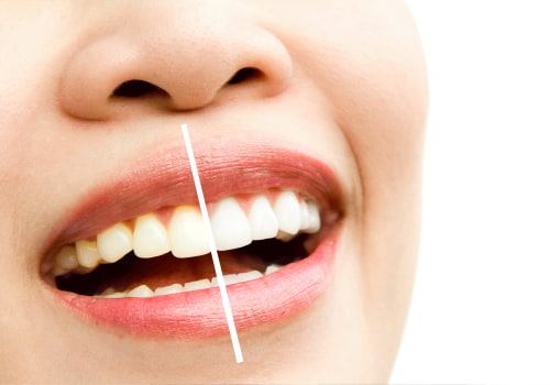 Smile Brighter with the Best Cosmetic Dentist in San Diego: Your Guide to Perfect Teeth